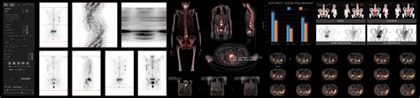 hermes scanner korrekturen|SPECT Reconstruction .